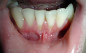 Пластика преддверия полости рта в стоматологии Апекс-Д